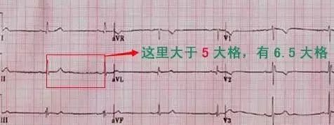 教你心电图，没有理由看不懂！