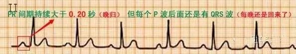 教你心电图，没有理由看不懂！
