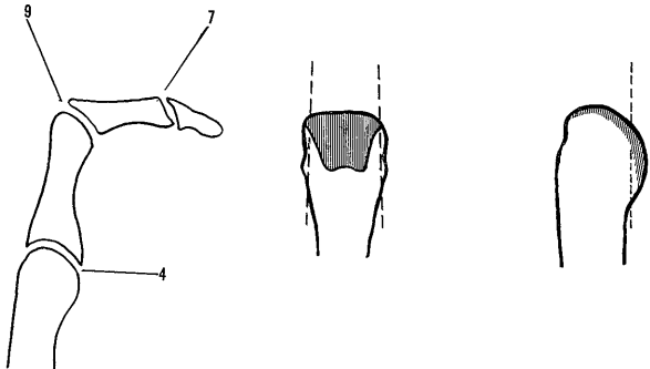 经关节截指——是否保留软骨?