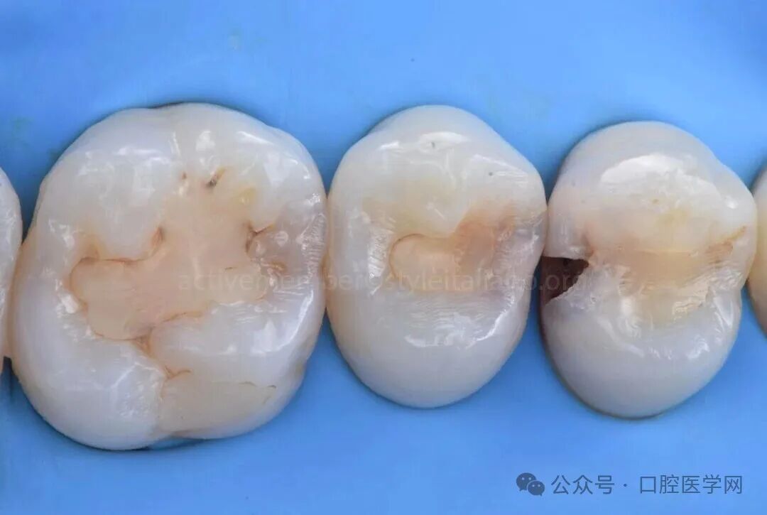 深龋:保守性单次就诊处理 - 好医术文章 - 好医术-赋能医生守护生命