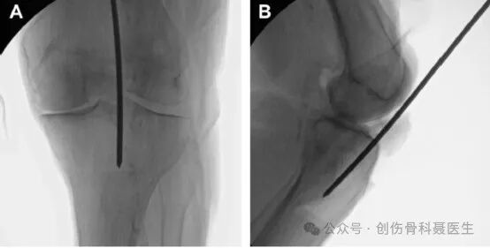 四肢骨折髓内钉固定的适应症与手术技巧