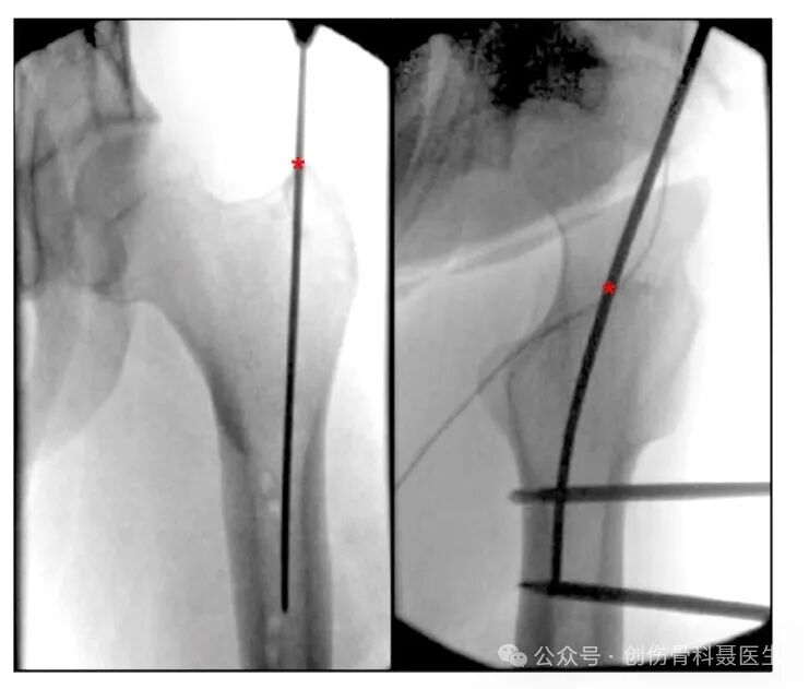 四肢骨折髓内钉固定的适应症与手术技巧