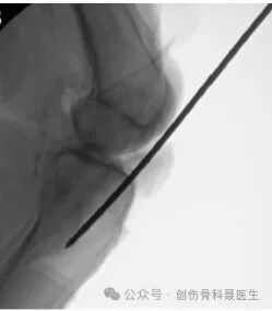 四肢骨折髓内钉固定的适应症与手术技巧