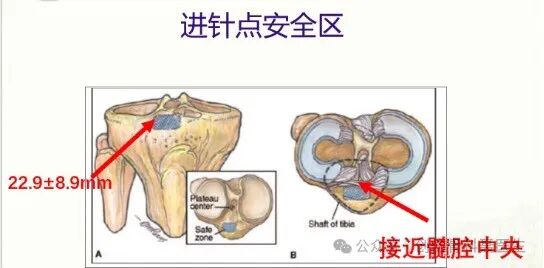 四肢骨折髓内钉固定的适应症与手术技巧