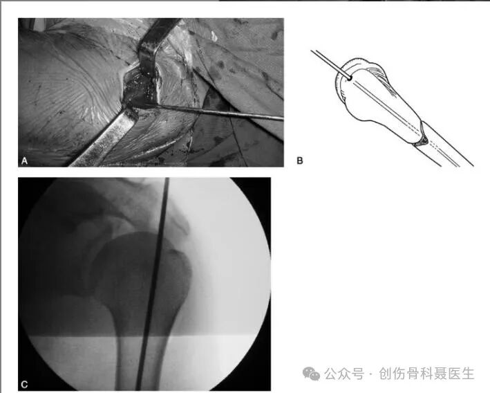 四肢骨折髓内钉固定的适应症与手术技巧