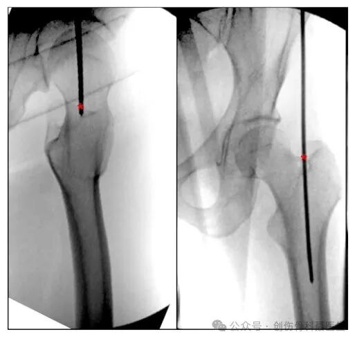 四肢骨折髓内钉固定的适应症与手术技巧