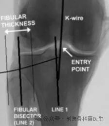 四肢骨折髓内钉固定的适应症与手术技巧