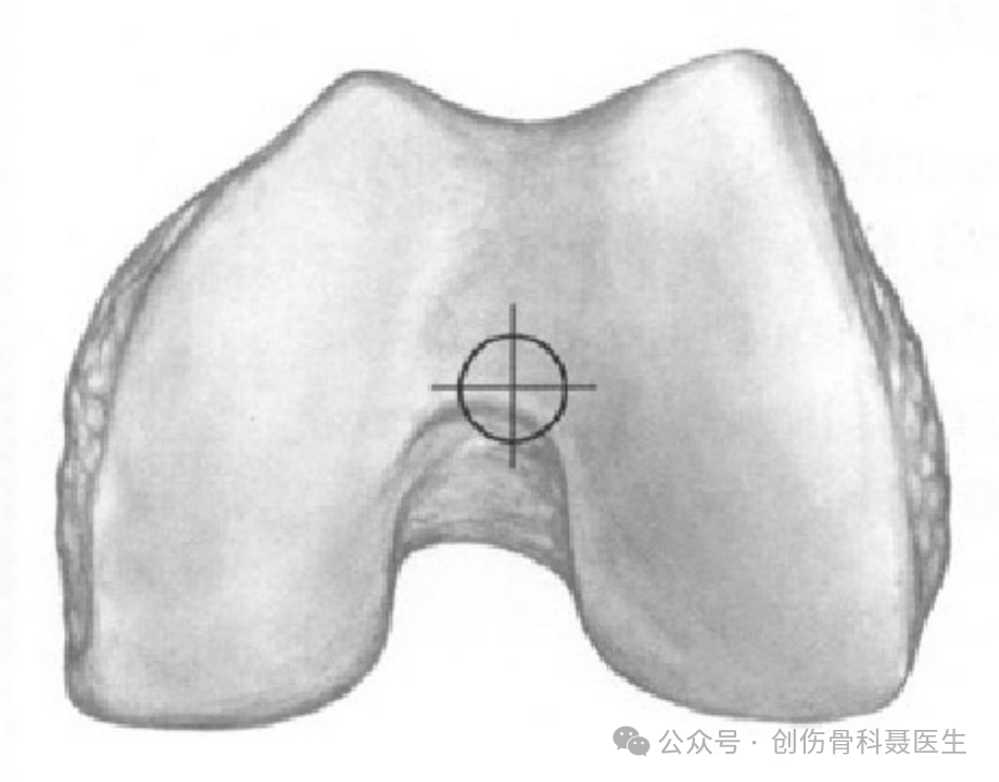 四肢骨折髓内钉固定的适应症与手术技巧