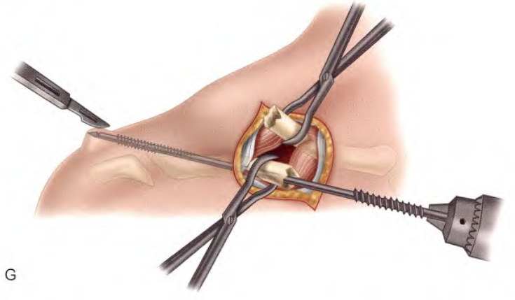 锁骨骨折:从分型到治疗的超全讲解,一文搞定!