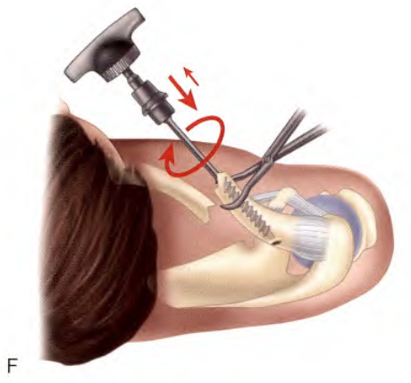 锁骨骨折:从分型到治疗的超全讲解,一文搞定!