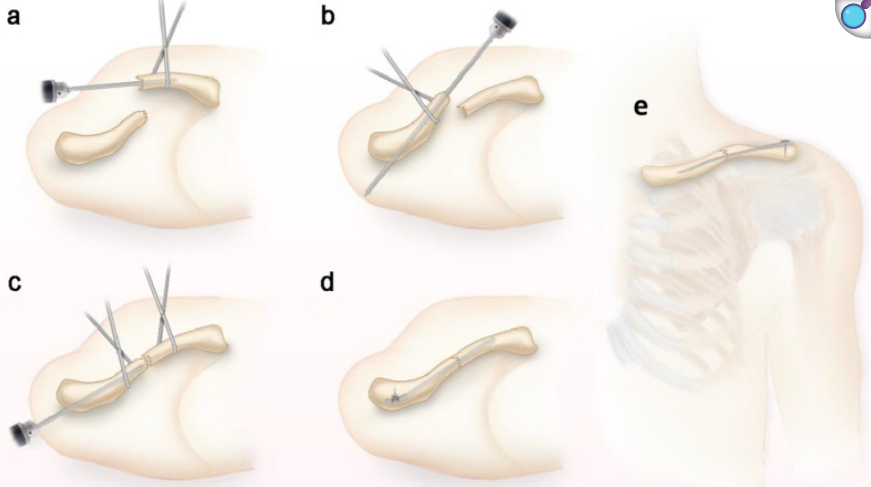 锁骨骨折:从分型到治疗的超全讲解,一文搞定!
