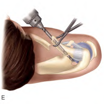 锁骨骨折:从分型到治疗的超全讲解,一文搞定!