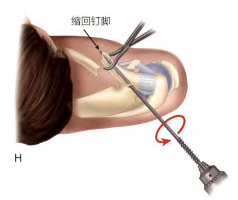 锁骨骨折:从分型到治疗的超全讲解,一文搞定!