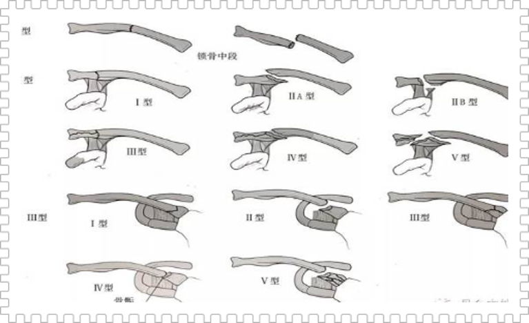 锁骨骨折:从分型到治疗的超全讲解,一文搞定!