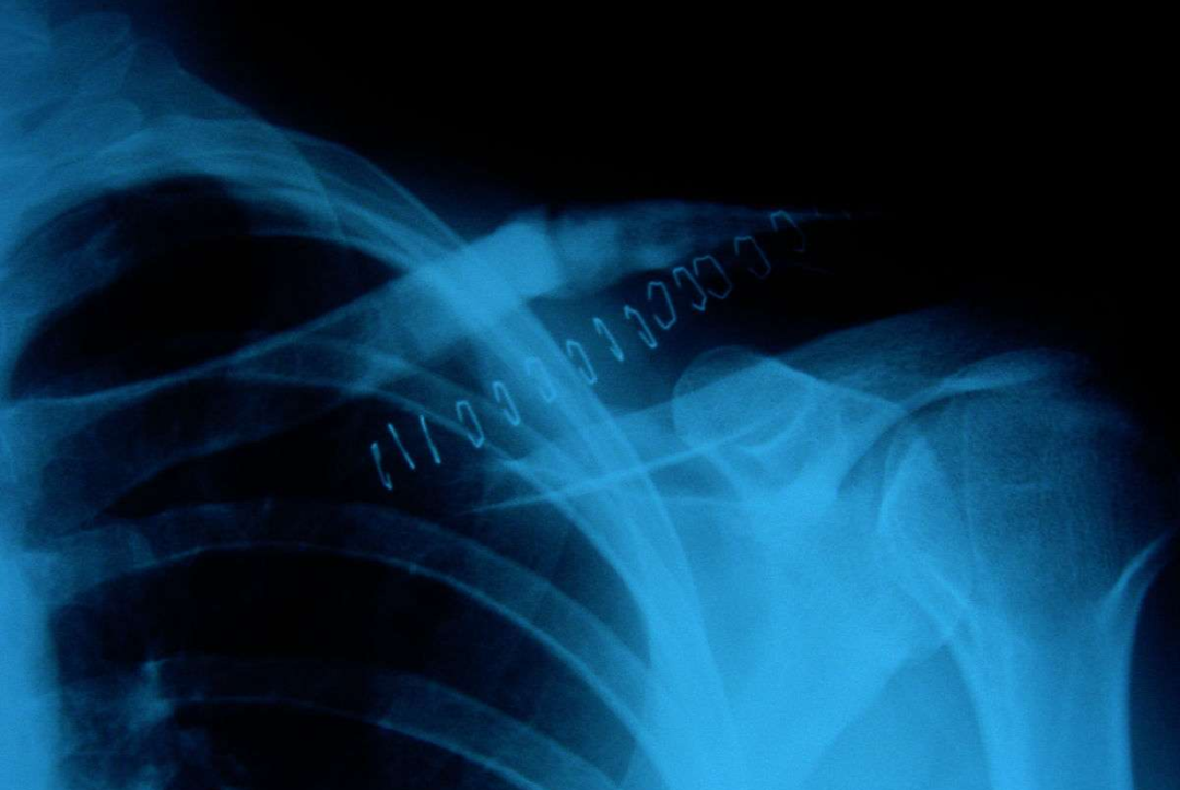 锁骨骨折:从分型到治疗的超全讲解,一文搞定!