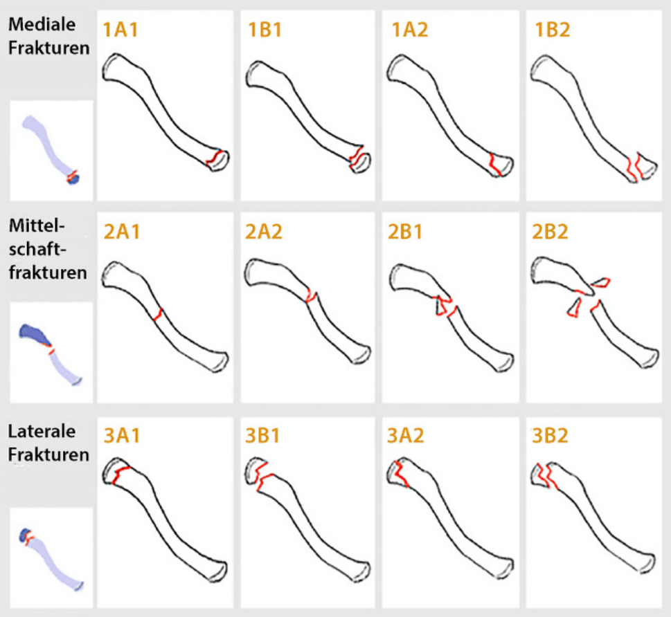 锁骨骨折:从分型到治疗的超全讲解,一文搞定!