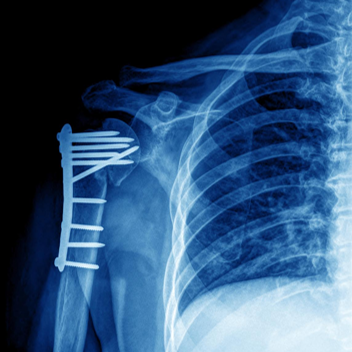 锁骨骨折:从分型到治疗的超全讲解,一文搞定!