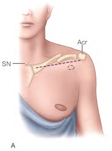 锁骨骨折:从分型到治疗的超全讲解,一文搞定!