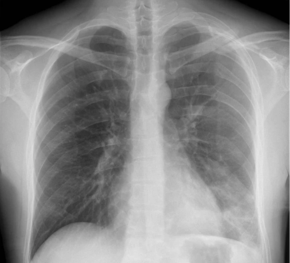 锁骨骨折:从分型到治疗的超全讲解,一文搞定!