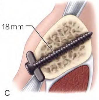 锁骨骨折:从分型到治疗的超全讲解,一文搞定!