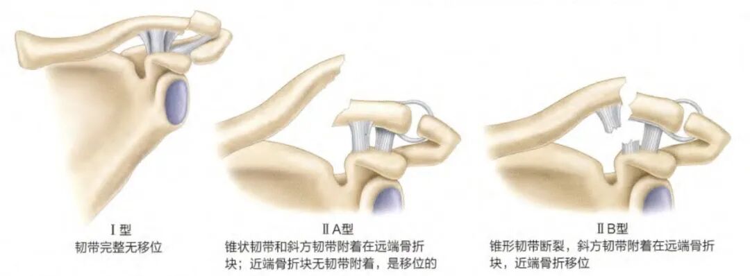 锁骨骨折:从分型到治疗的超全讲解,一文搞定!
