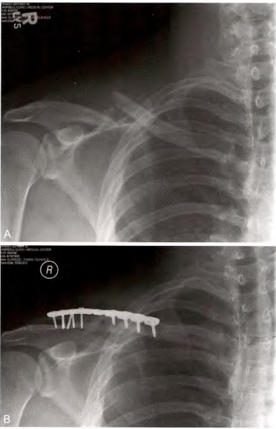 锁骨骨折:从分型到治疗的超全讲解,一文搞定!