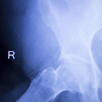 锁骨骨折:从分型到治疗的超全讲解,一文搞定!