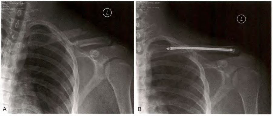 锁骨骨折:从分型到治疗的超全讲解,一文搞定!