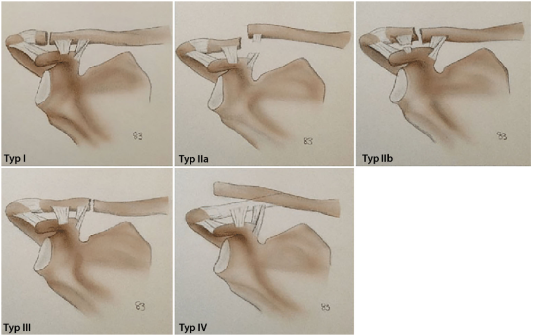 锁骨骨折:从分型到治疗的超全讲解,一文搞定!