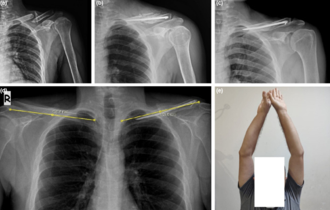 锁骨骨折:从分型到治疗的超全讲解,一文搞定!