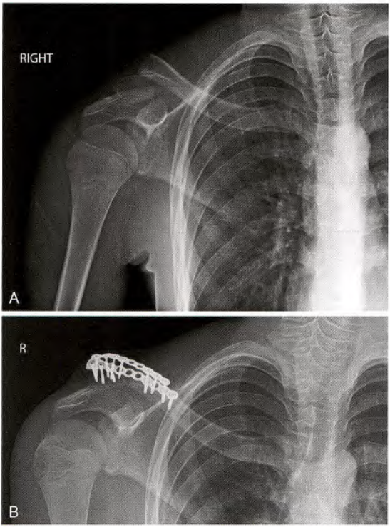 锁骨骨折:从分型到治疗的超全讲解,一文搞定!