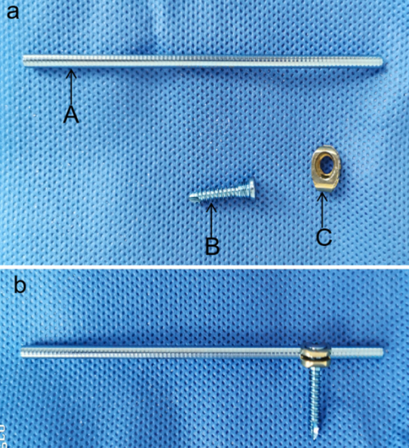 锁骨骨折:从分型到治疗的超全讲解,一文搞定!