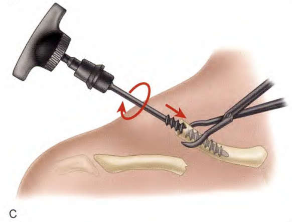 锁骨骨折:从分型到治疗的超全讲解,一文搞定!