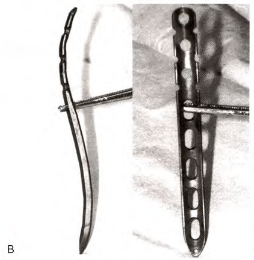 锁骨骨折:从分型到治疗的超全讲解,一文搞定!