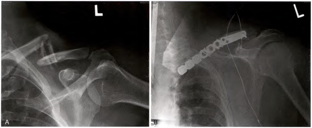 锁骨骨折:从分型到治疗的超全讲解,一文搞定!