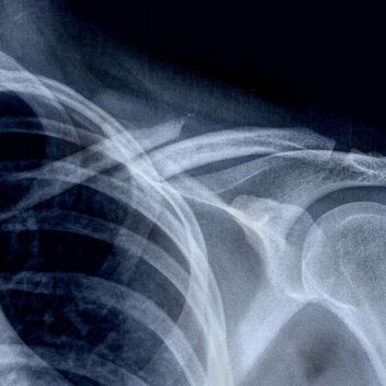 锁骨骨折:从分型到治疗的超全讲解,一文搞定!