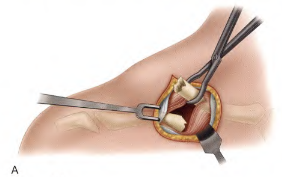 锁骨骨折:从分型到治疗的超全讲解,一文搞定!
