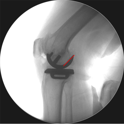 【读懂单髁】从读懂X-ray开始:术后摄片技术及垫片位置解读