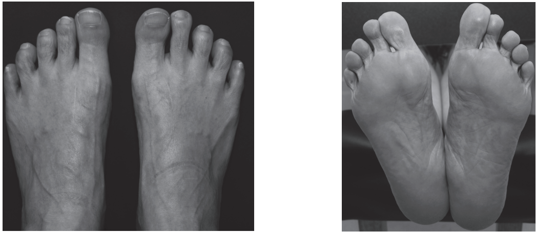 【手术技巧】拇外翻非截骨韧带联合术(Syndesmosis