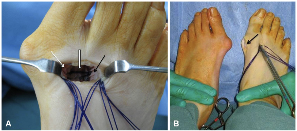 【手术技巧】拇外翻非截骨韧带联合术(Syndesmosis