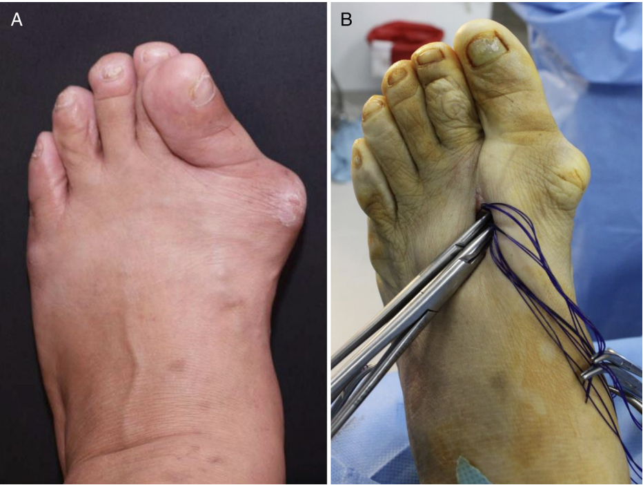 【手术技巧】拇外翻非截骨韧带联合术(Syndesmosis