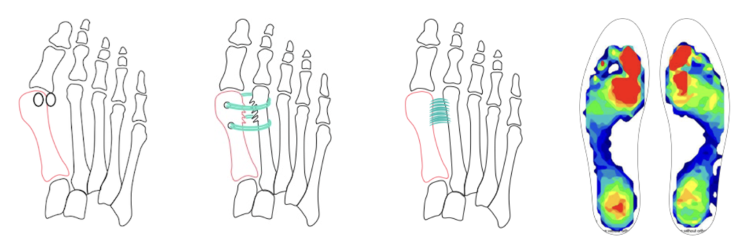 【手术技巧】拇外翻非截骨韧带联合术(Syndesmosis