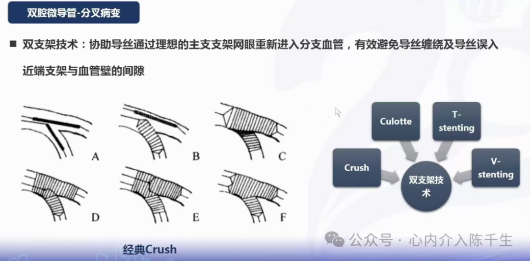 冠状动脉慢性完全闭塞病变介入治疗学习笔记：微导管的选择和操作技术
