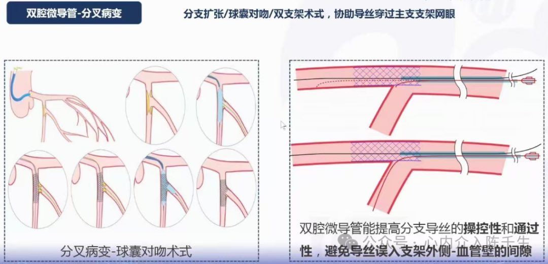 冠状动脉慢性完全闭塞病变介入治疗学习笔记：微导管的选择和操作技术