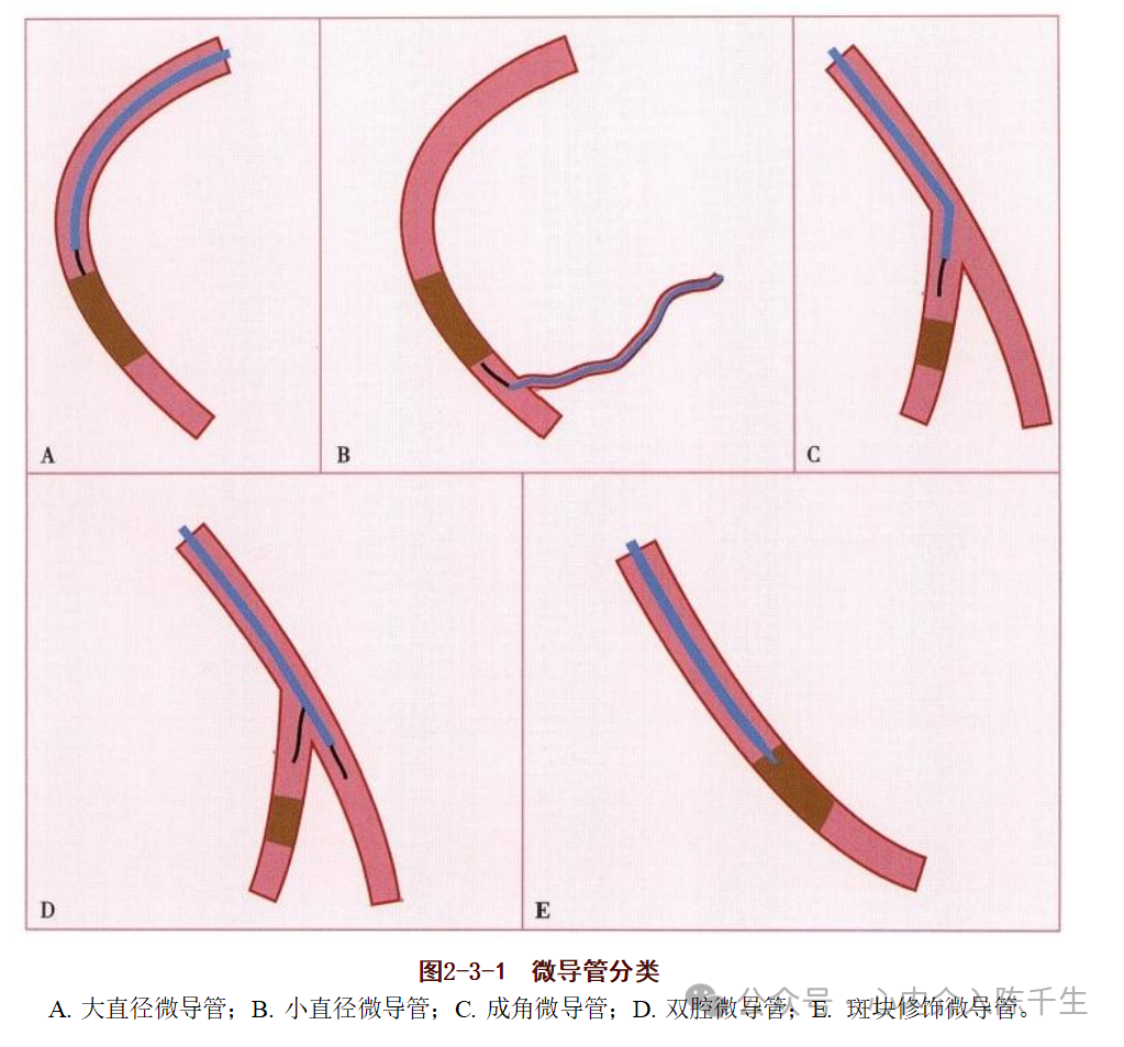 冠状动脉慢性完全闭塞病变介入治疗学习笔记：微导管的选择和操作技术