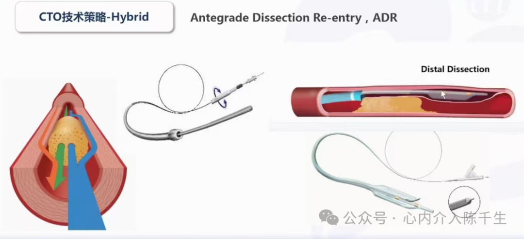 冠状动脉慢性完全闭塞病变介入治疗学习笔记：微导管的选择和操作技术