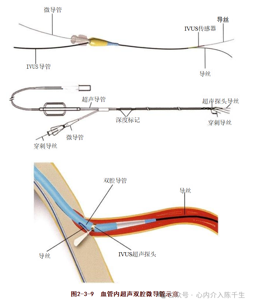 冠状动脉慢性完全闭塞病变介入治疗学习笔记：微导管的选择和操作技术