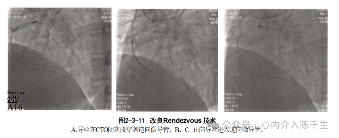 冠状动脉慢性完全闭塞病变介入治疗学习笔记：微导管的选择和操作技术