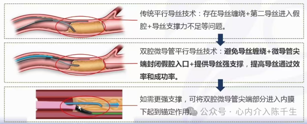 冠状动脉慢性完全闭塞病变介入治疗学习笔记：微导管的选择和操作技术