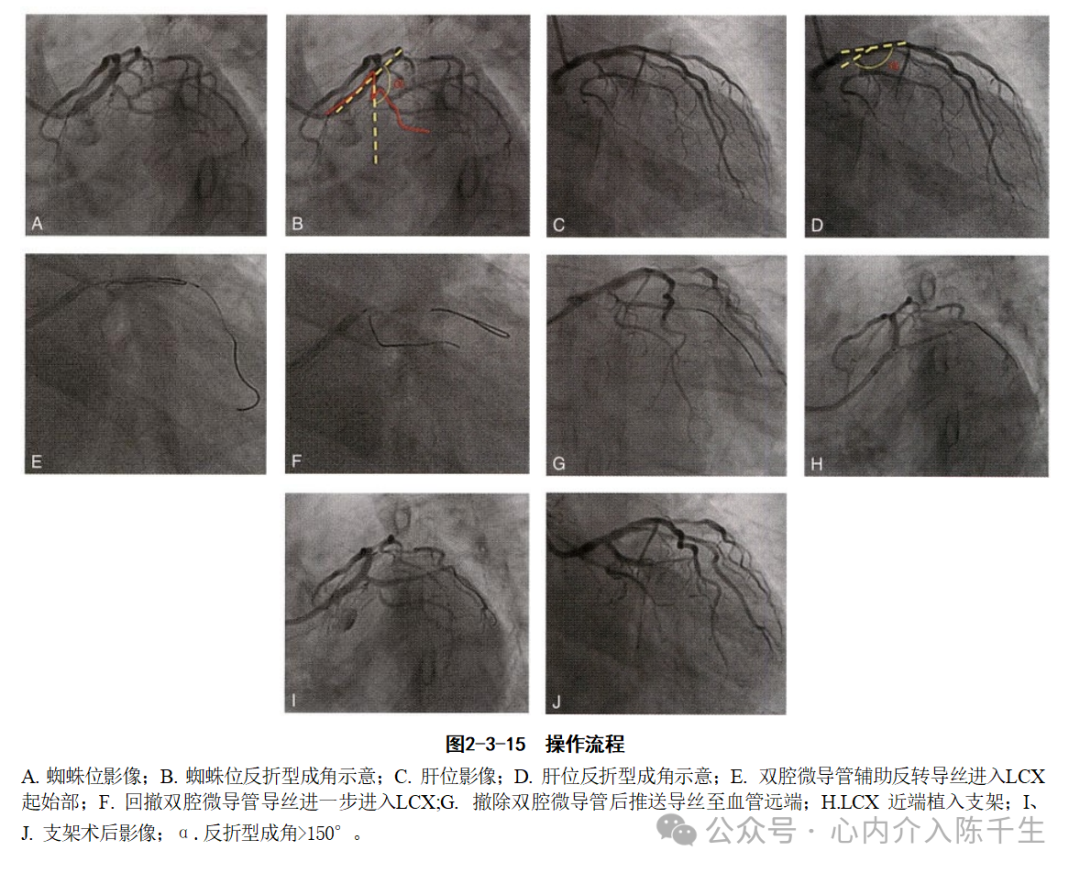 冠状动脉慢性完全闭塞病变介入治疗学习笔记：微导管的选择和操作技术